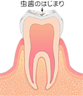 C0 歯の表面が溶ける