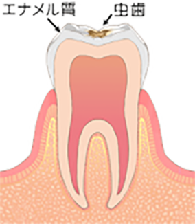 C1初期の虫歯