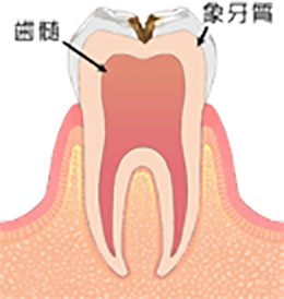 C2歯の内部まで進行した虫歯