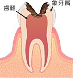 C3神経まで進行した虫歯