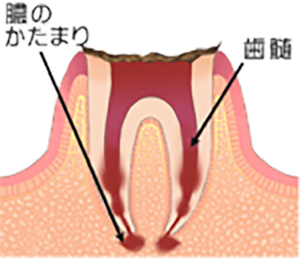 C4歯の根(歯質)が失われた歯